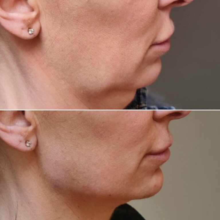Endolift Laser per lifting, lassità cutanee e grasso localizzato Milano
