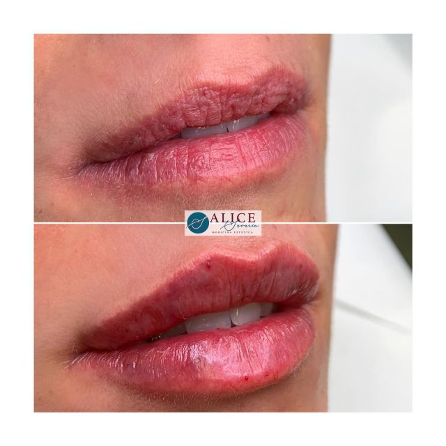•FILLER LABBRA con TECNICA PERSONALE•

Nel tempo ho elaborato una mia tecnica personale al fine di dare il meglio per le mie pazienti. Sono serviti anni di studio, innumerevoli corsi per imparare dai migliori a livello internazionale, analisi dei prodotti e tanta, tanta pratica.
•
Ci vuole una profonda conoscenza anatomica per trattare le labbra nel modo corretto, nonché delle caratteristiche dell’acido ialuronico che si sceglie di iniettare. Infine, l’elemento veramente determinante, la TECNICA. 
•
•
🌐www.alicesavarin.com
📲 +39 3888020224
•
•
•
•
•
•
•
•
#medicinaestetica #estetica #botox #medicina #filler #bellezza #beauty #peeling #dermatologia #lifting #cellulite #rimini #spa #lips #chirurgiaestetica #chirurgiaplastica #acidoialuronico #fillerlabbra #skincare #mesoterapia #chirurgia #medicinaesteticasavarin #medicinaesteticarimini #lenticchieprontee #medicinaesteticamilano #fillerlabbramilano #lipfiller #teoxane