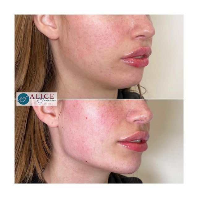 • DEFINIZIONE LINEA MANDIBOLARE •

👩🏻‍⚕️Il trattamento della linea mandibolare (o jawline filler) è una procedura medico estetica minimamente invasiva in grado di donare maggiore definizione all’area di transizione tra viso e collo. La linea mandibolare diventa più definita, il viso assume un carattere più deciso 🤩
•
➡️ I Filler più utilizzati per la dedizione della linea mandibolare includono:
💉 acido ialuronico 
💉 idrossiapatite di calcio
•
⏱I risultati sono immediatamente visibili e si mantengono per circa 12 mesi. 
•
🌐www.alicesavarin.com
📲 +39 388 8020224
•
•
•
•
#medicinaestetica #estetica #botox #medicina #filler #bellezza #beauty #peeling #dermatologia #lifting #cellulite #rimini #spa #lips #chirurgiaestetica #chirurgiaplastica #acidoialuronico #fillerlabbra #skincare #mesoterapia #chirurgia #medicinaesteticasavarin  #medicinaesteticarimini #teoxane