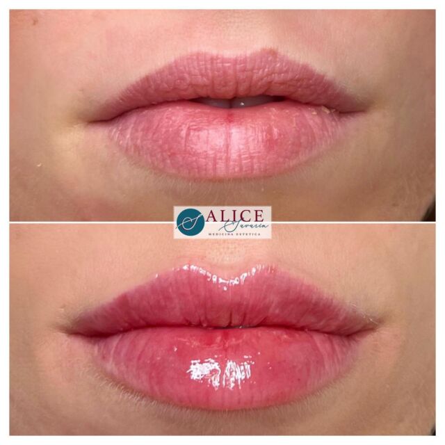 • FILLER LABBRA • Milano 💋

👩🏻‍⚕️ Una richiesta molto frequente è la correzione di asimmetrie delle labbra
•
👉🏻Impostando il trattamento in modo adeguato e iniettando in modo da rimodellare il labbro nel modo desiderato è possibile migliorare se non azzerare le asimmetrie. 
•
Non sempre è possibile ottenere una correzione ottimale nella prima seduta, spesso infatti la correzione di asimmetrie richiede circa due sedute a distanza di qualche mese l’una dall’altra. Una volta raggiunto il risultato desiderato si potrà impostare un percorso di mantenimento con trattamento sempre più rarefatti nel tempo.
•
Tagga la tua amica che vorrebbe migliorare la simmetria e le proporzioni delle labbra! 😍
•
🌐www.alicesavarin.com
📲 +39 3888020224
•
•
•
•
#medicinaestetica #estetica #botox #medicina #filler #bellezza #beauty #peeling #dermatologia #lifting #cellulite #rimini #spa #lips #chirurgiaestetica #chirurgiaplastica #acidoialuronico #fillerlabbra #skincare #mesoterapia #chirurgia #medicinaesteticasavarin #medicinaesteticarimini #medicinaesteticamilano #fillerlabbramilano #lipfiller #teoxane