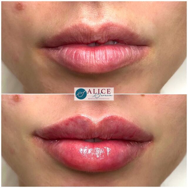 • FILLER LABBRA & ASIMMETRIE • Questa paziente aveva eseguito in passato un filler labbra senza però ottenere alcuna correzione dell’asimmetria del labbro superiore. Anzi, l’unica cosa ottenuta era stata un peggioramento di tale condizione con la creazione di un’ulteriore asimmetria al labbro inferiore. 
•
Impostando il trattamento in modo adeguato e iniettando in modo da rimodellare il labbro nel modo desiderato è stato possibile migliorare se non azzerare le asimmetrie presenti. Vedere la paziente emozionarsi vedendo le sue nuove labbra è stato veramente gratificante 🥰
•
Anche voi avete delle asimmetrie che vorreste migliorare? Oppure, con i trattamenti passati avete avuto risultati soddisfacenti? 
Scrivetemelo nei commenti, vi ascolto!
•
•
🌐www.alicesavarin.com
📲 +39 3888020224
•

•
#filler #bellezza #beauty #peeling #lips #chirurgiaestetica #chirurgiaplastica #acidoialuronico #fillerlabbra #skincare #medicinaesteticamilano #medicinaesteticasavarin #fillerlabbramilano #lipfiller #russianlips #rinofiller